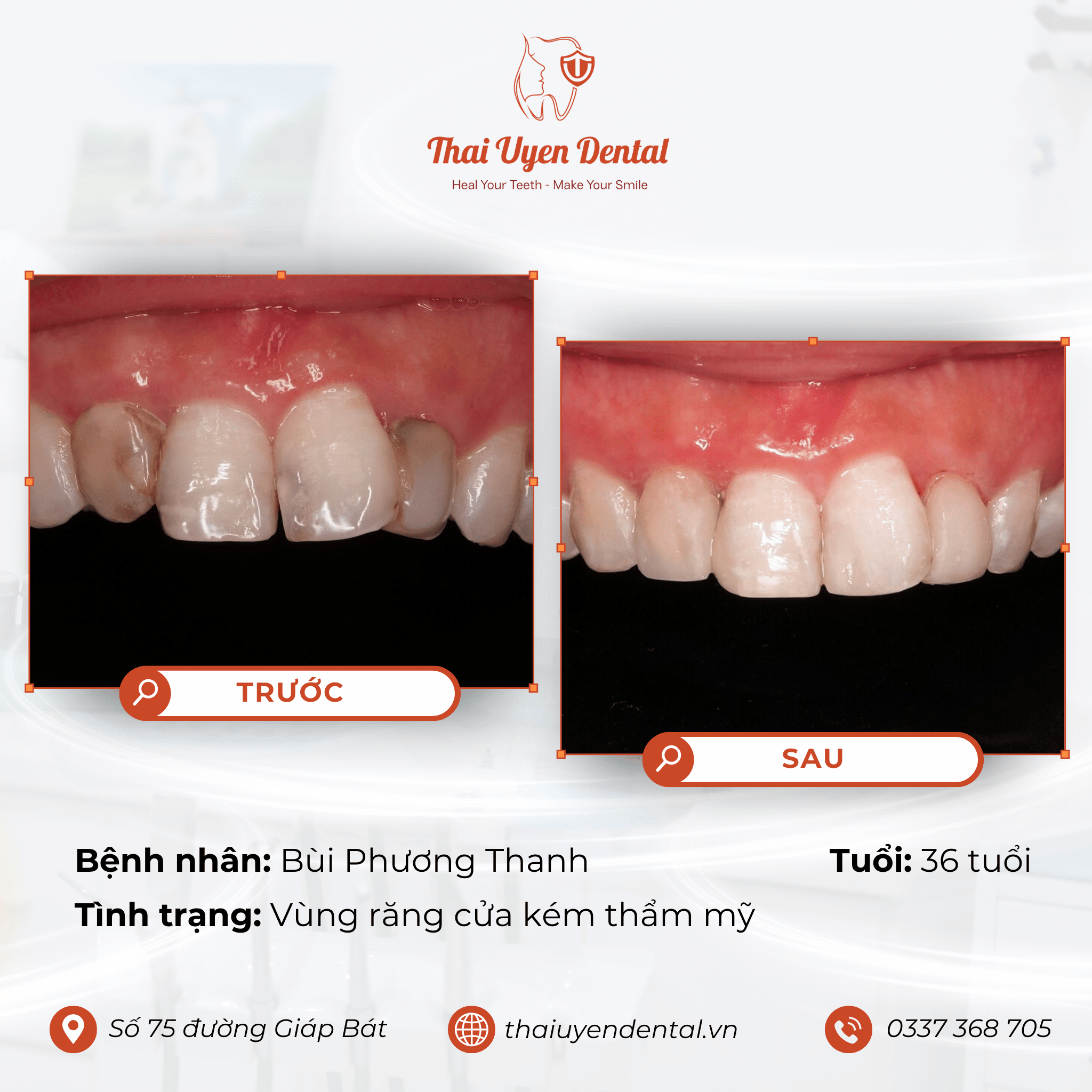 Bệnh nhân Bùi Phương Thanh tại Thai Uyen Dental (ảnh 1)