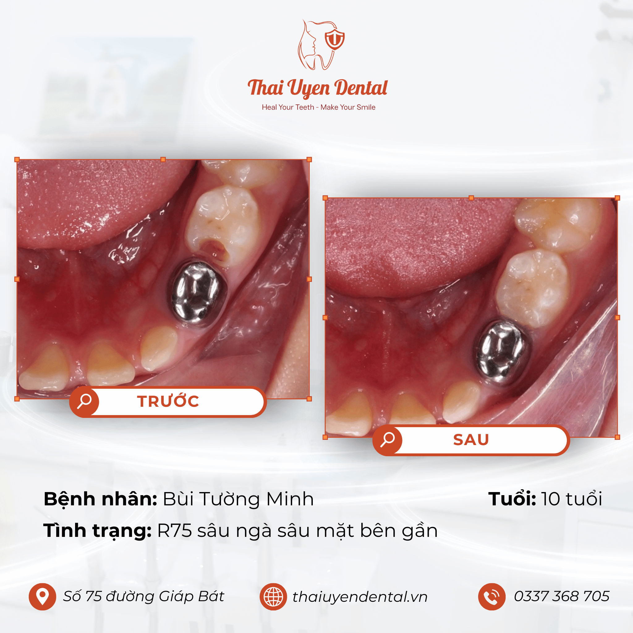Bệnh nhân Bùi Tường Minh tại Thai Uyen Dental (ảnh 1)