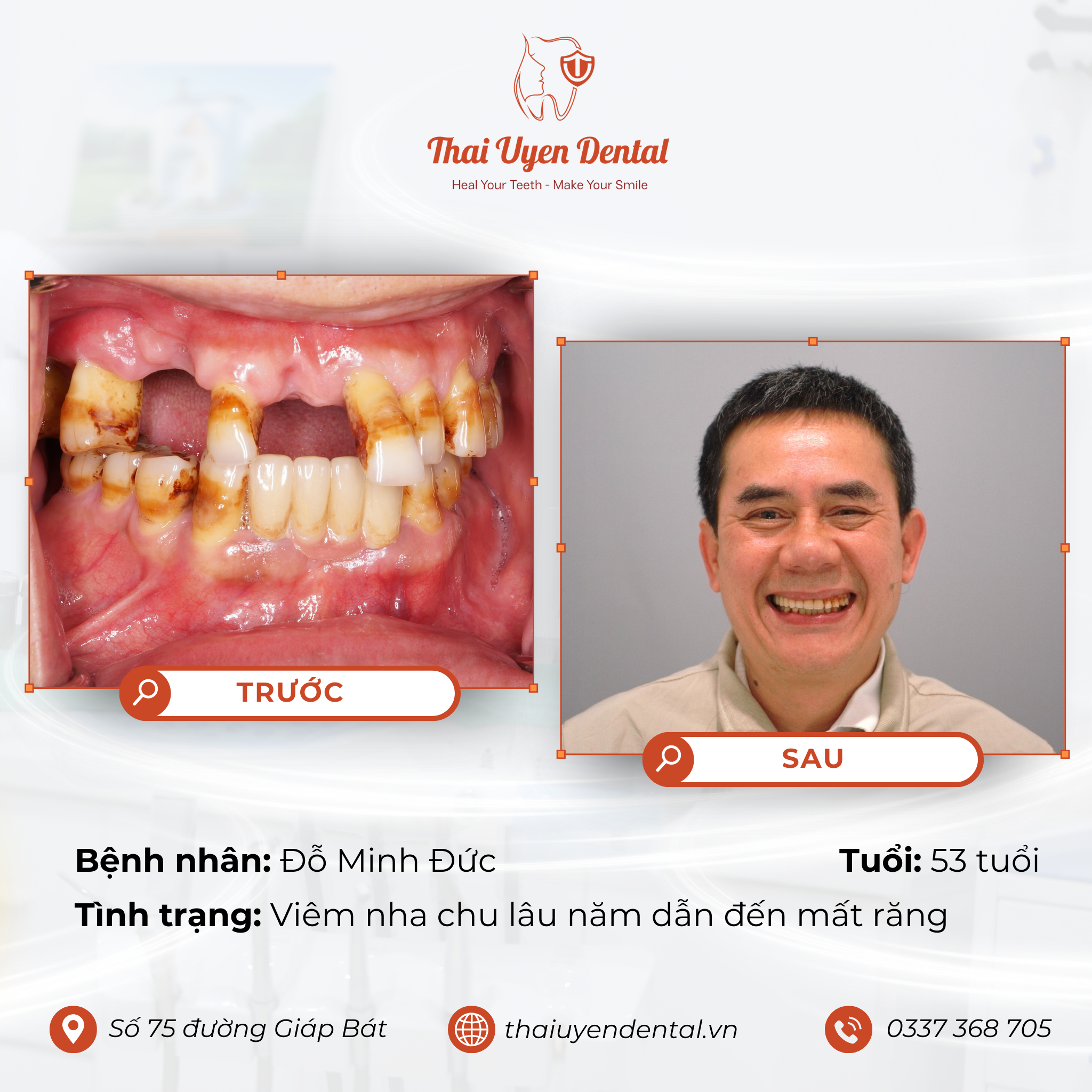 Bệnh nhân Đỗ Minh Đức tại Thai Uyen Dental (ảnh 1)