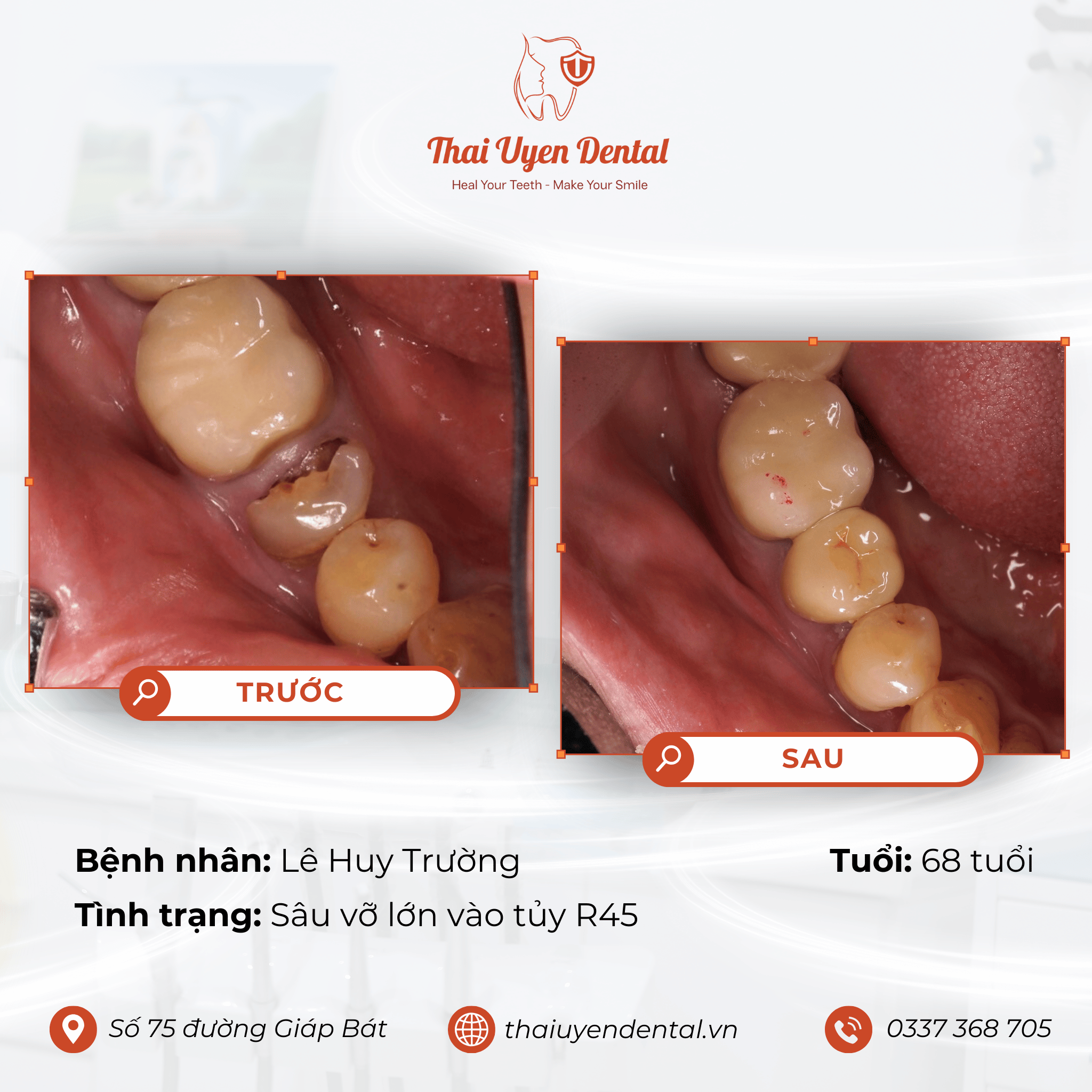 Bệnh nhân Lê Huy Trường tại Thai Uyen Dental (ảnh 1)