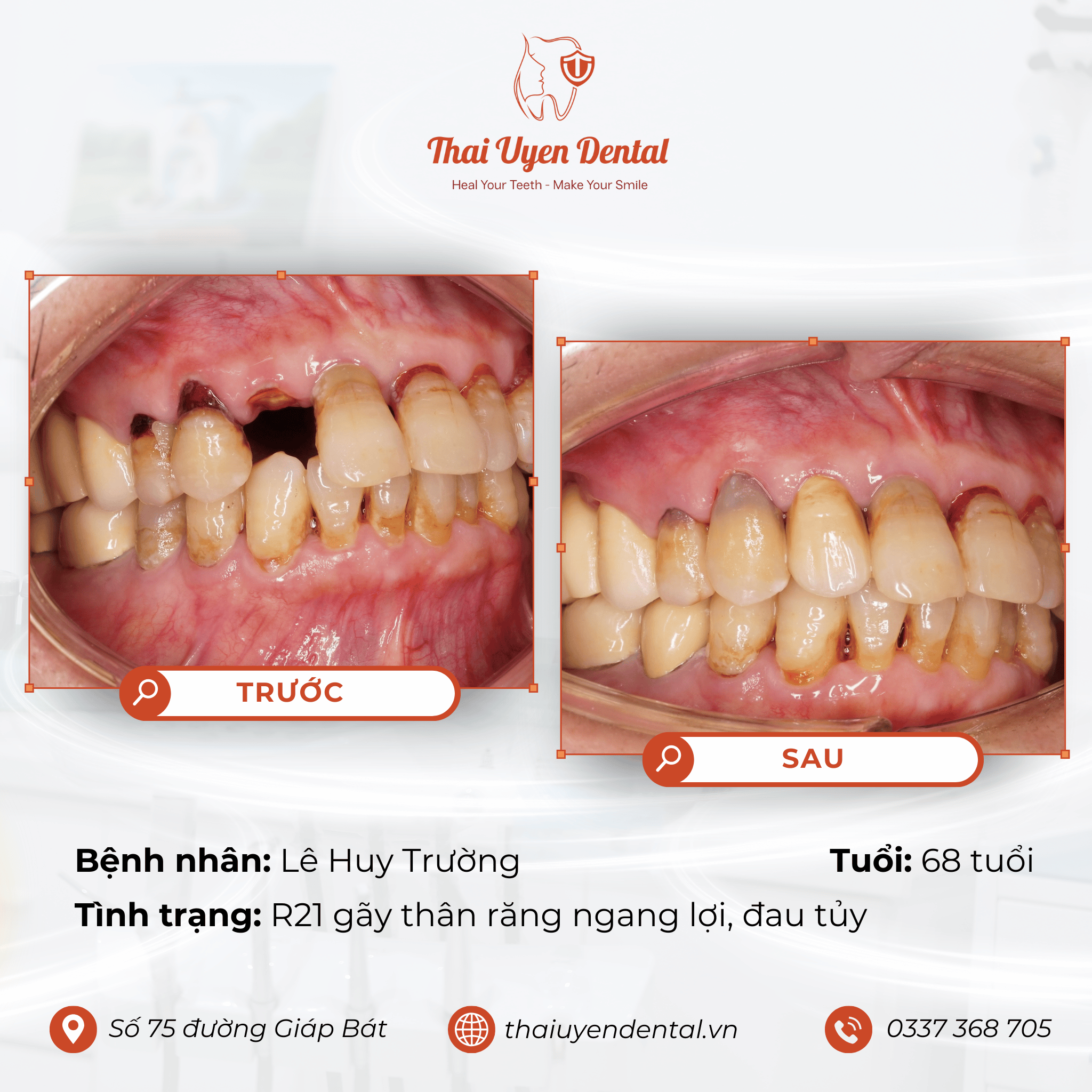 Bệnh nhân Lê Huy Trường tại Thai Uyen Dental (ảnh 2)