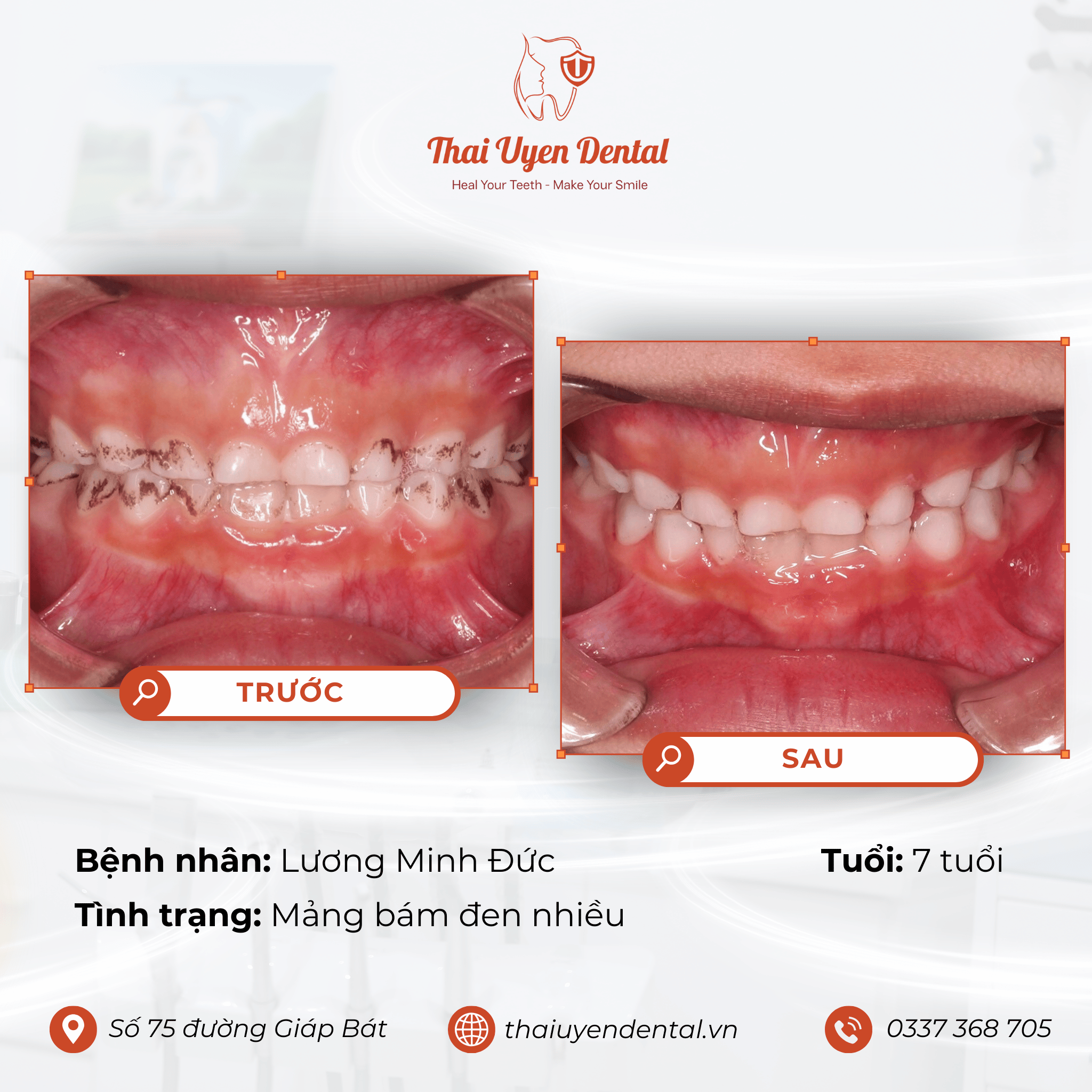 Bệnh nhân Lương Minh Đức tại Thai Uyen Dental (ảnh 1)