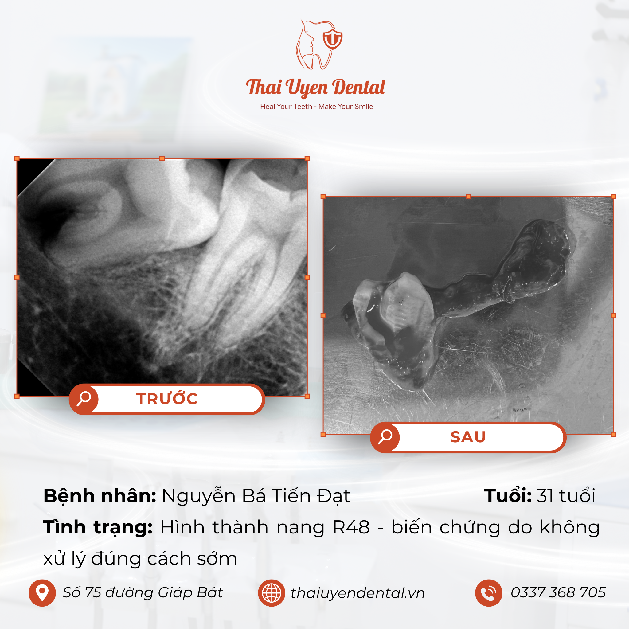 Bệnh nhân Nguyễn Bá Tiến Đạt tại Thai Uyen Dental (ảnh 1)
