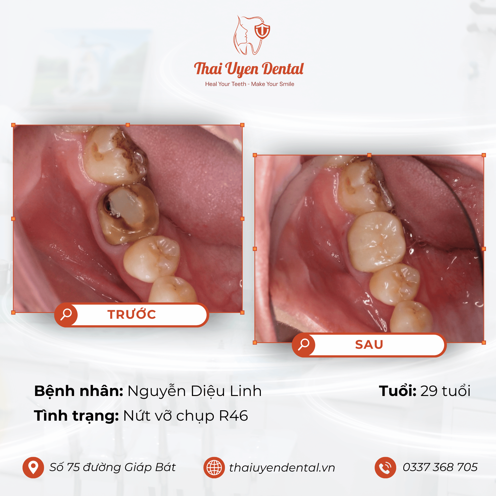 Bệnh nhân Nguyễn Diệu Linh tại Thai Uyen Dental (ảnh 1)