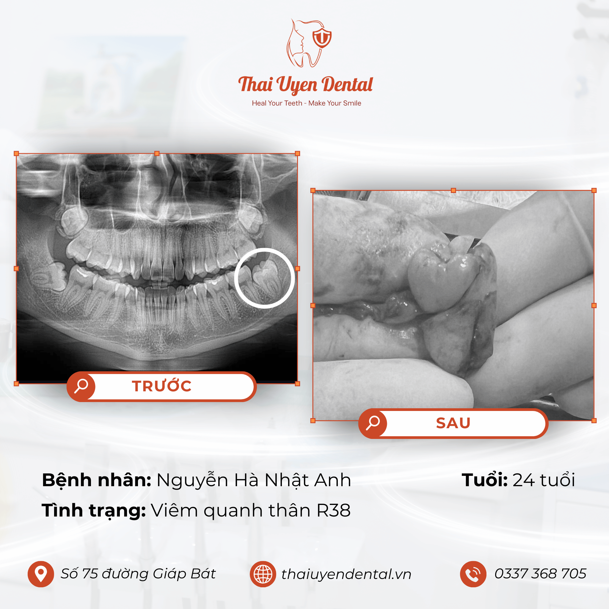 Bệnh nhân Nguyễn Hà Nhật Anh tại Thai Uyen Dental (ảnh 1)