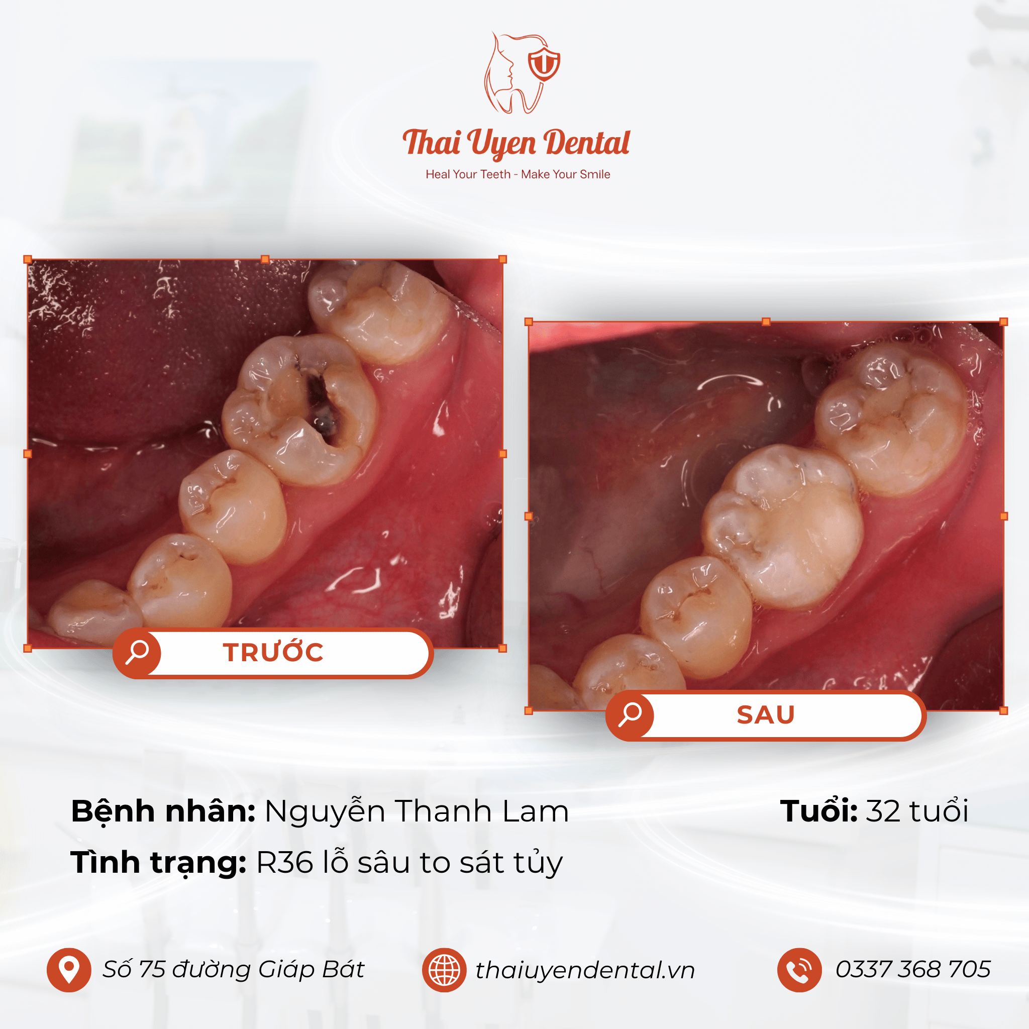 Bệnh nhân Nguyễn Thanh Lam tại Thai Uyen Dental (ảnh 1)