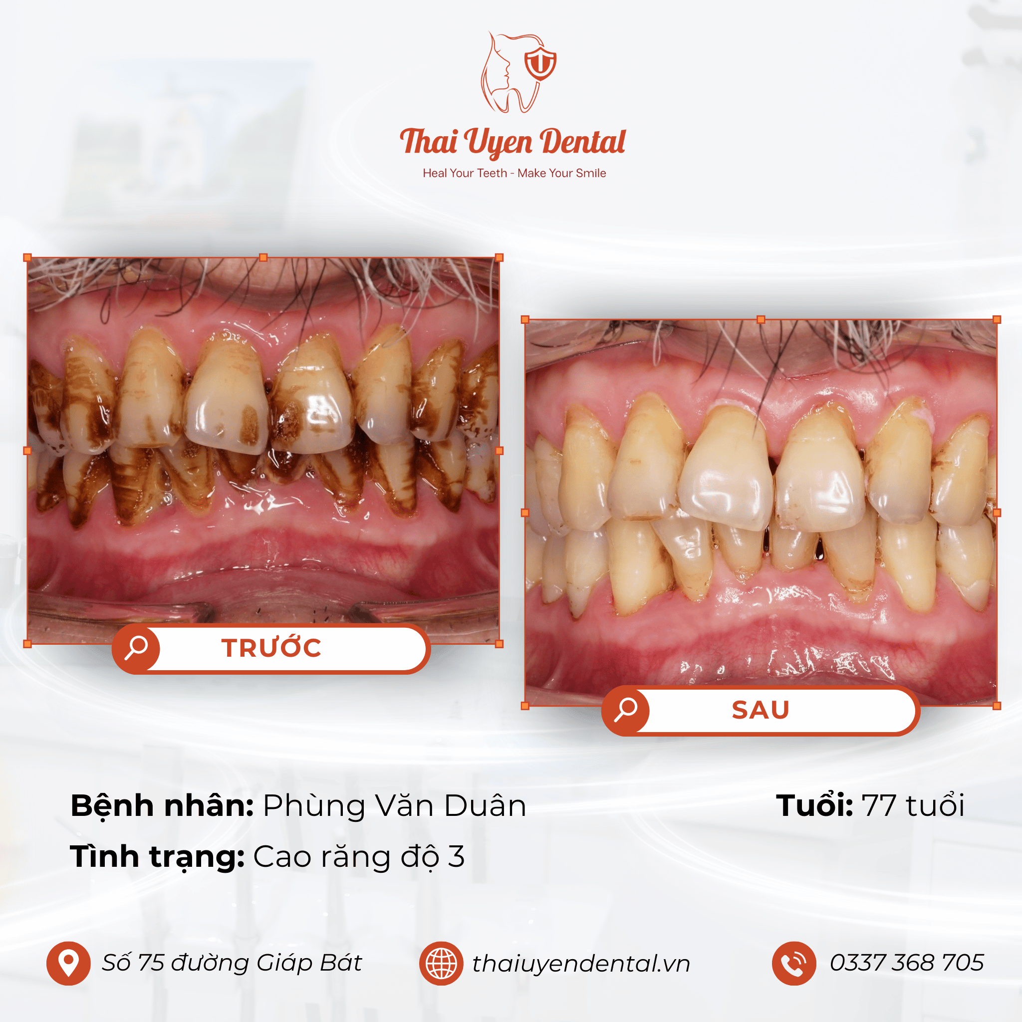 Bệnh nhân Phùng Văn Duẩn tại Thai Uyen Dental (ảnh 1)
