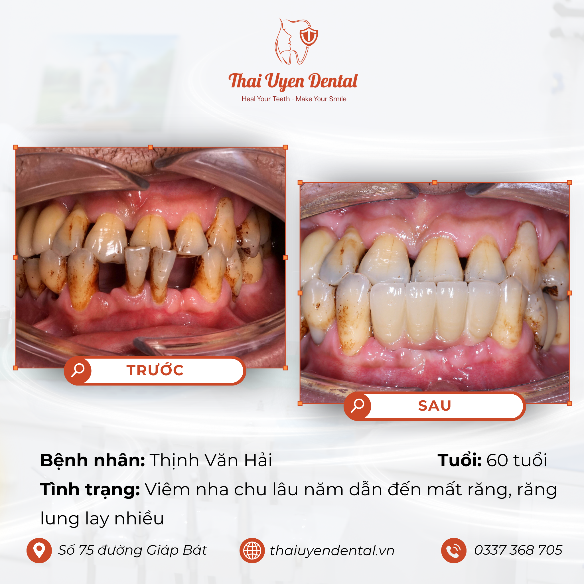 Bệnh nhân Thịnh Văn Hải tại Thai Uyen Dental (ảnh 1)
