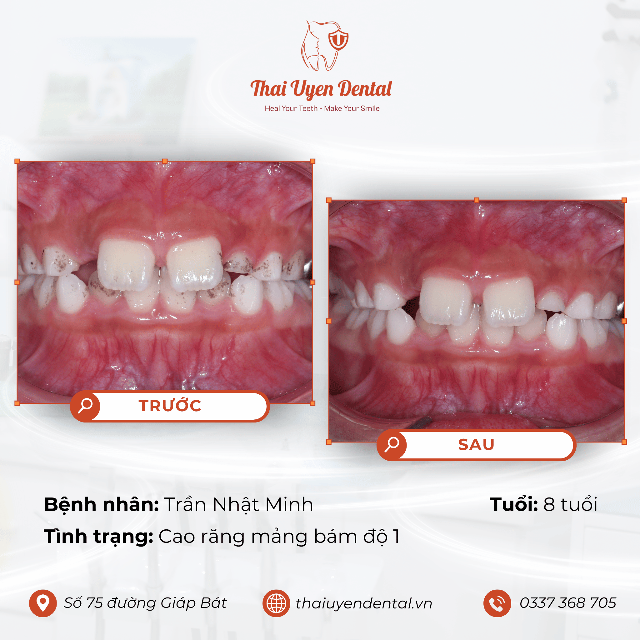 Bệnh nhân Trần Nhật Minh tại Thai Uyen Dental (ảnh 1)
