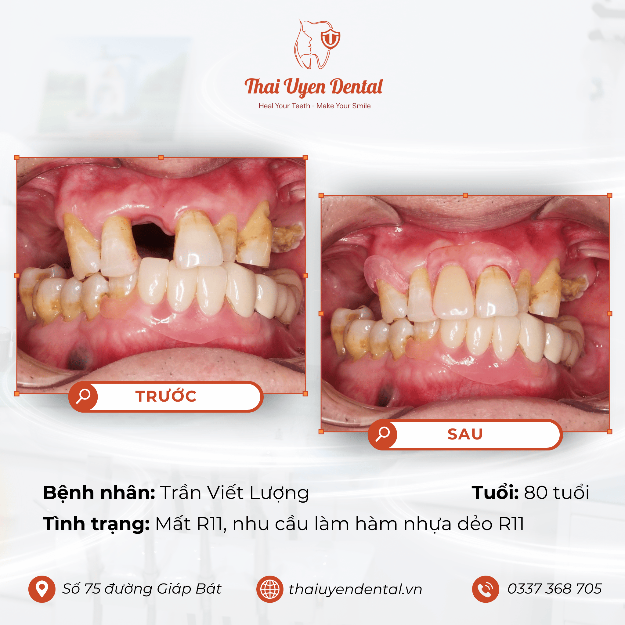 Bệnh nhân Trần Viết Lượng tại Thai Uyen Dental (ảnh 1)