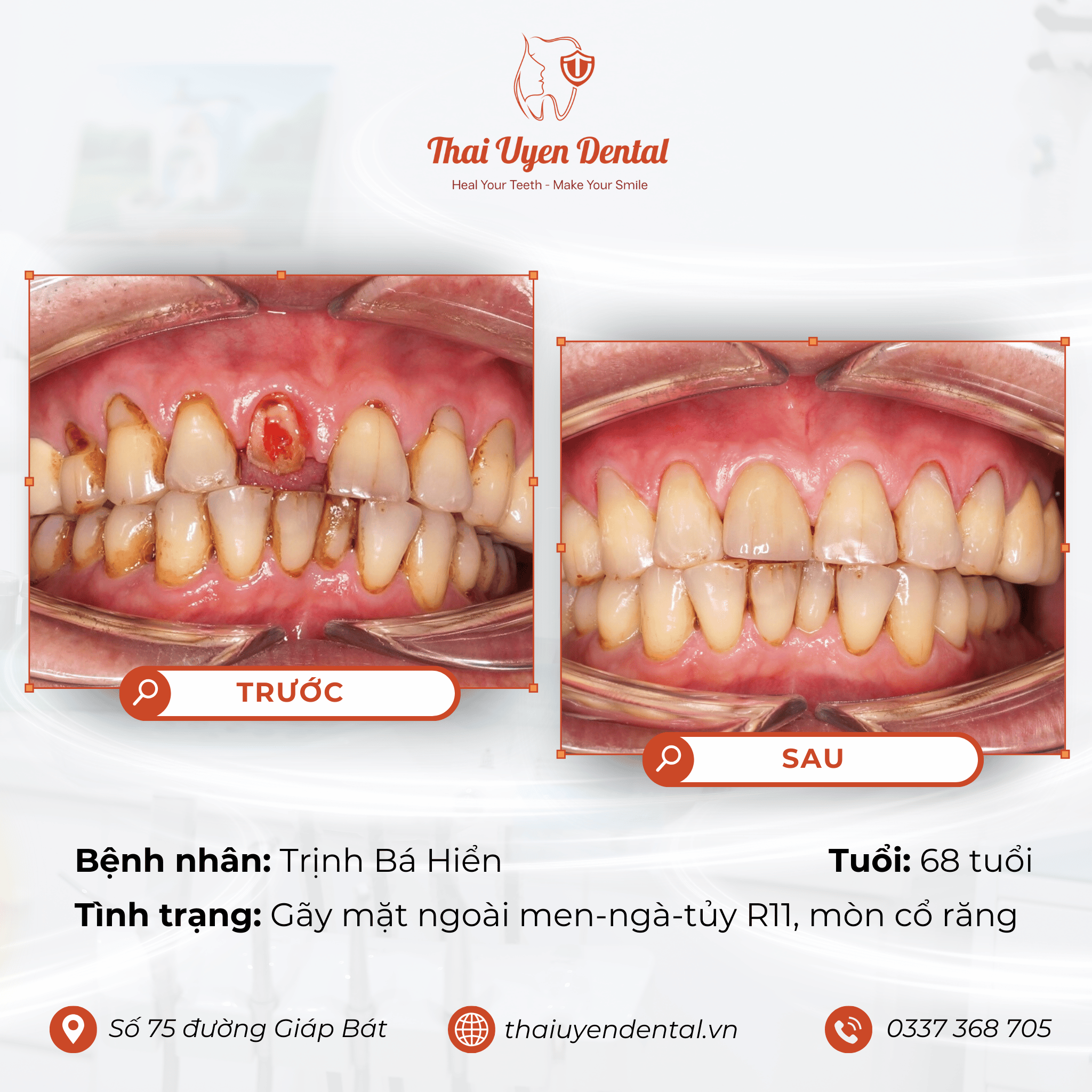 Bệnh nhân Trịnh Bá Hiển tại Thai Uyen Dental (ảnh 1)
