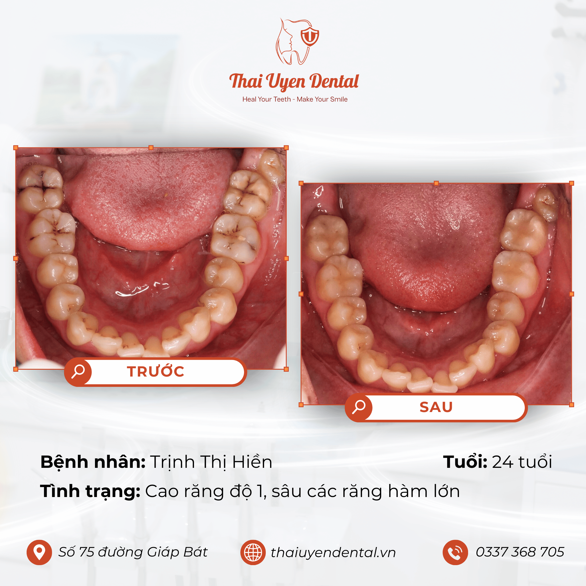 Bệnh nhân Trịnh Thị Hiền tại Thai Uyen Dental (ảnh 1)