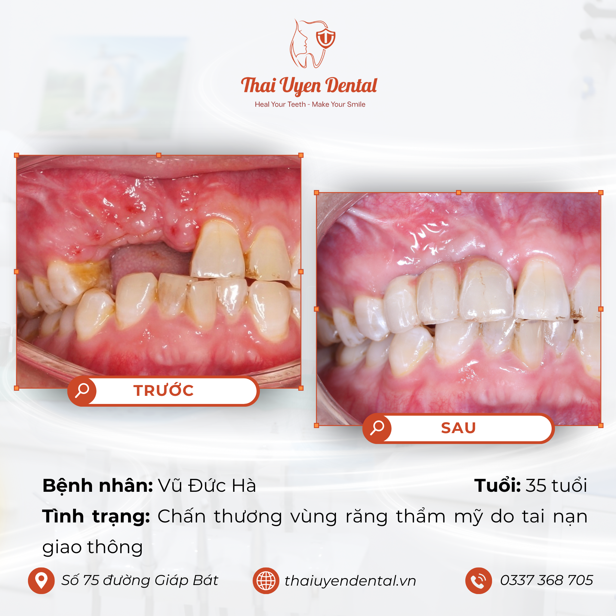 Bệnh nhân Vũ Đức Hà tại Thai Uyen Dental (ảnh 1)