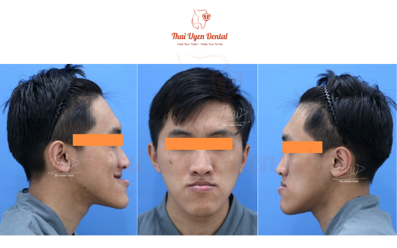 Minh họa bệnh nhân nhô hàm dưới, mặt lưỡi cày